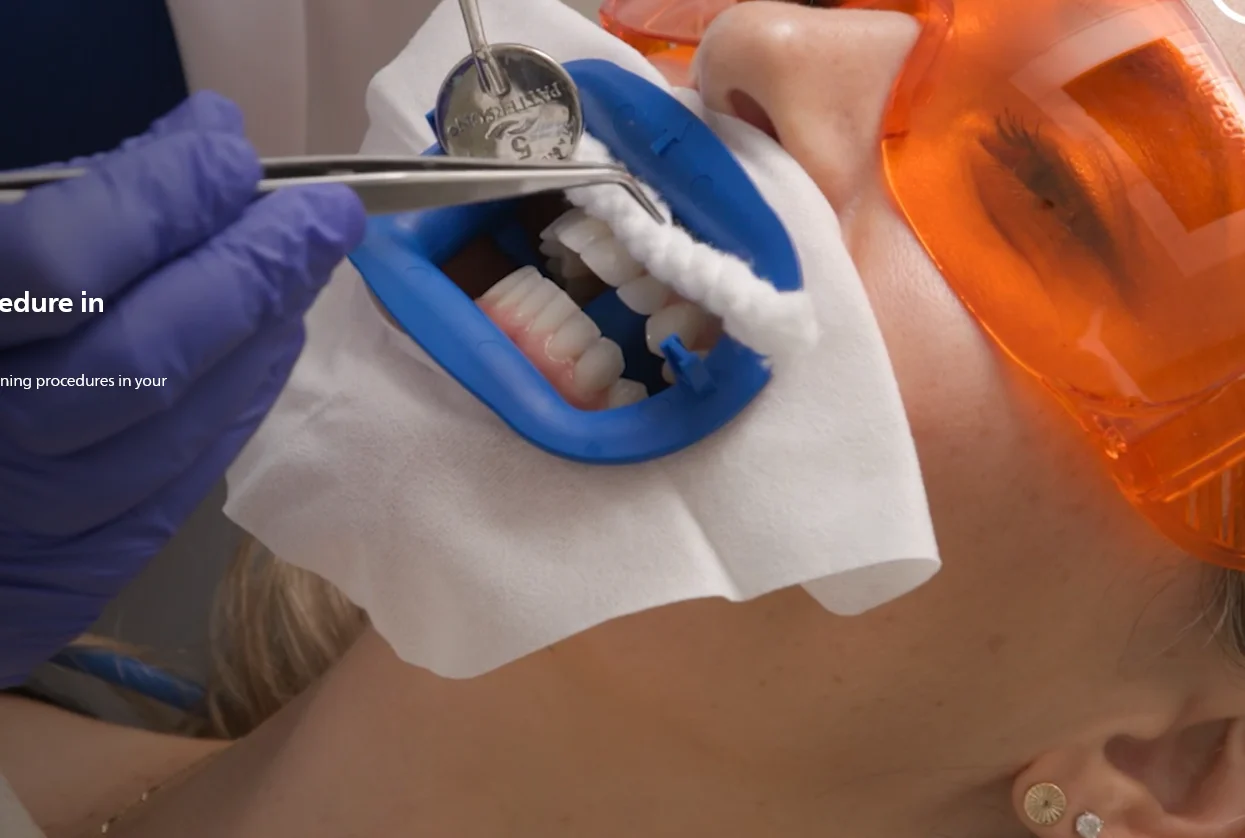 Professional Office Philips Zoom Whitening Kit Chairside Light-Activated, 2 Person Complete Procedures Teeth Whiteninhg Zoom Kit