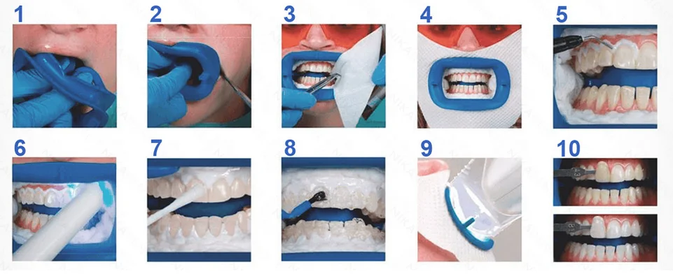 Professional Office Philips Zoom Whitening Kit Chairside Light-Activated, 2 Person Complete Procedures Teeth Whiteninhg Zoom Kit